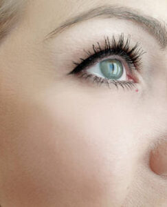 woman eye wrinkles before and after procedures