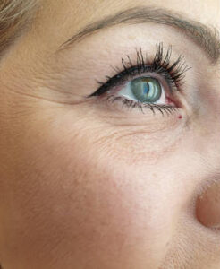 woman eye wrinkles before and after procedures