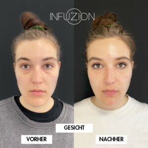 2020-09 Model 1 mit INFUZION 2x Boozter 1x Voly DE