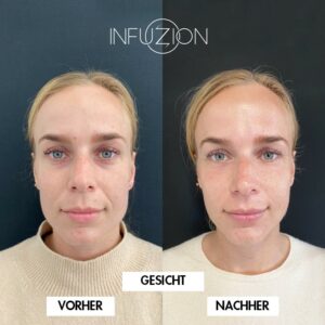 2020-09 Model 2 mit INFUZION 2x Boozter 1x Voly DE